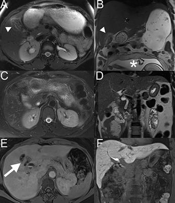 Gallbladder cancer during pregnancy treated with surgery and adjuvant gemcitabine: A case report and review of the literature